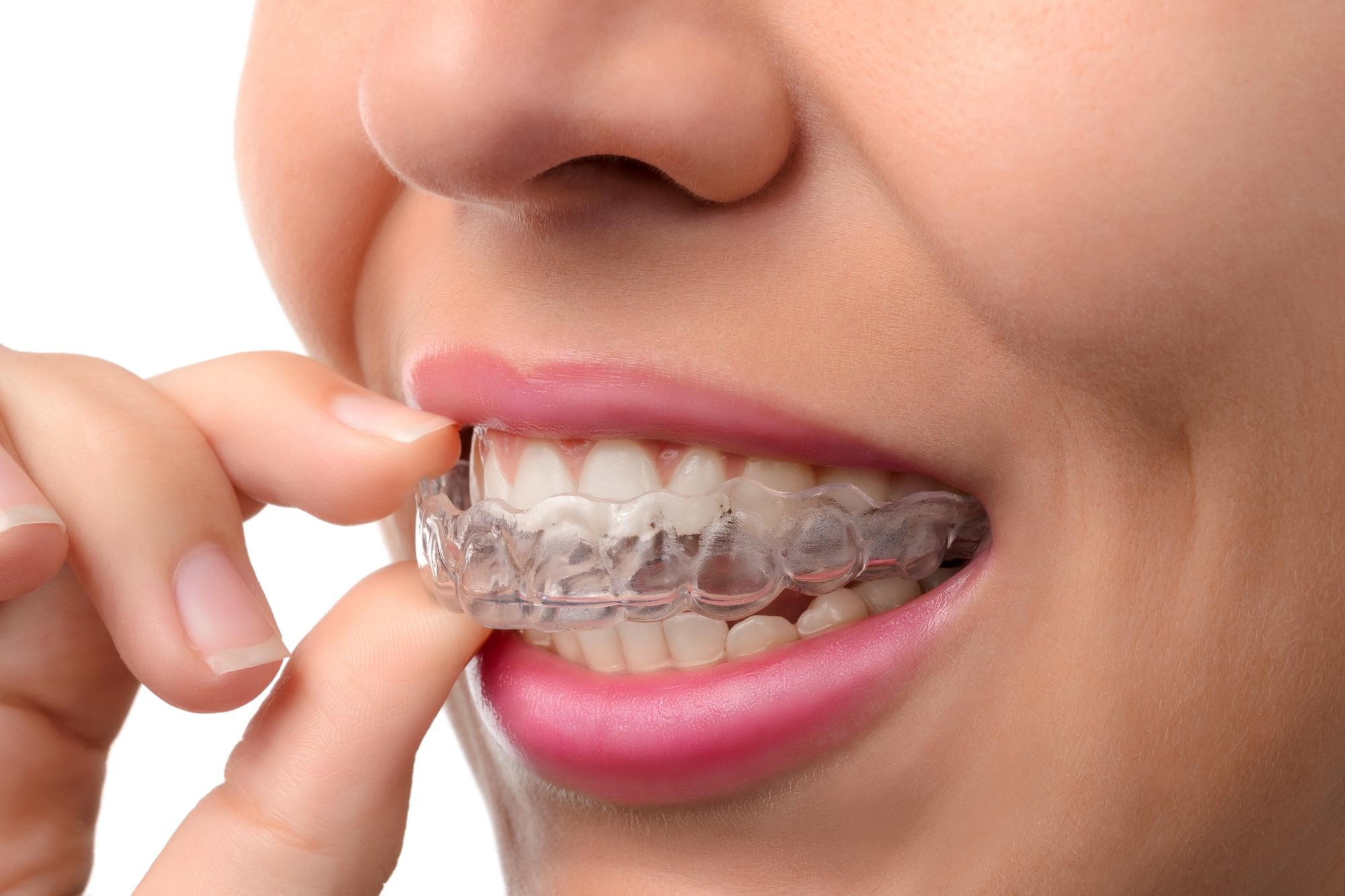 Four Factors that Influence the Cost of Invisalign - Dentist in Rio Rancho,  NM